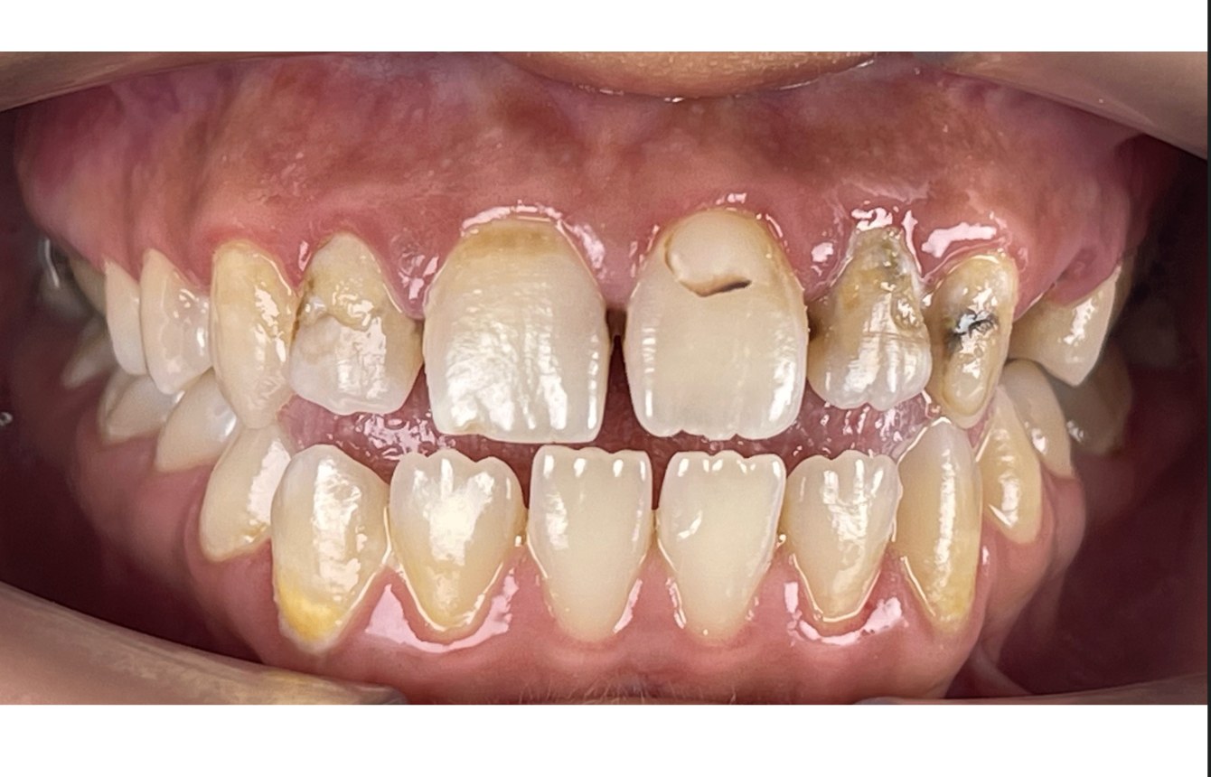 Avant — cas 1 Dr. Jihan Agdam