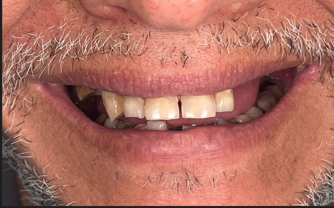 Avant — cas 1 Dr. Talbi Marouane