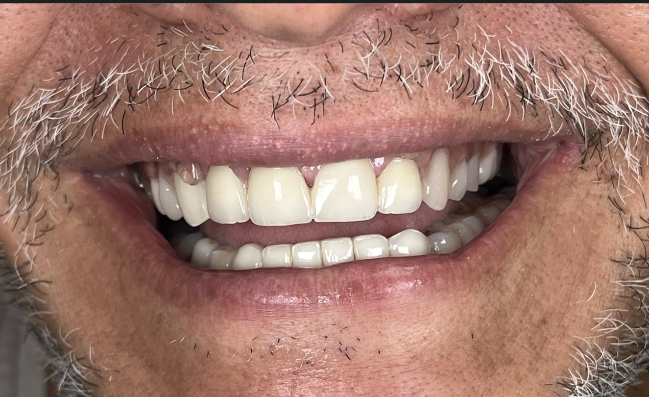 Après — cas 1 Dr. Talbi Marouane