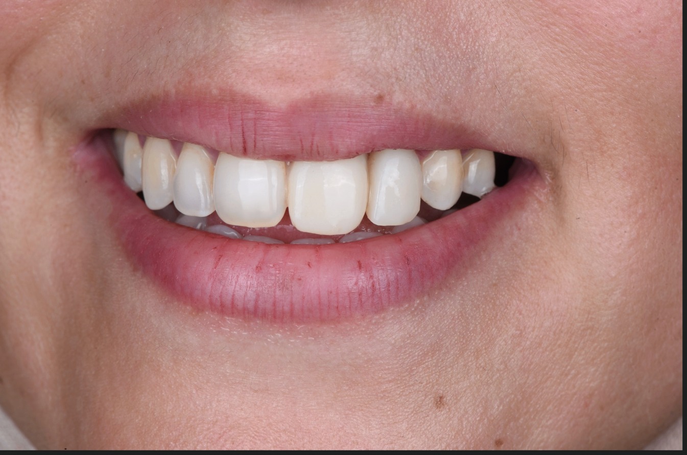 Après — cas 2 Dr. Talbi Marouane