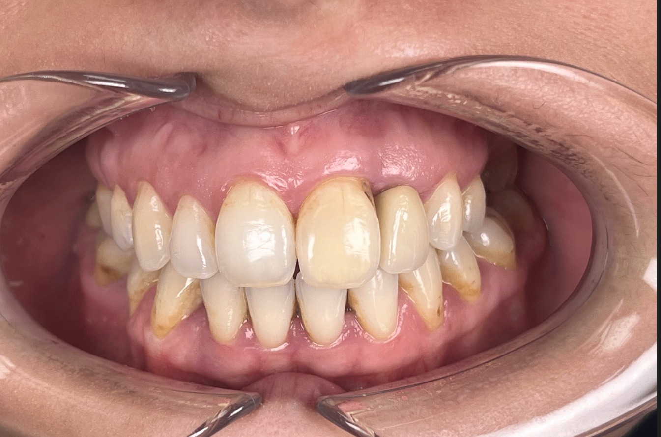 Avant — cas 2 Dr. Talbi Marouane